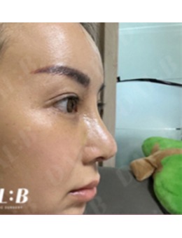 韓國Dal:B整形外科鼻整形前后對比絕了!改善鼻梁山根矮/鼻子短,平地起高樓真的贊~