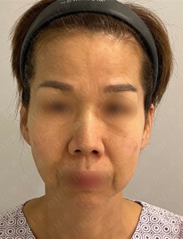 韓國Dal:B整形外科面部抗衰前后對比顯著,皺紋和膚質(zhì)都得到了改善!