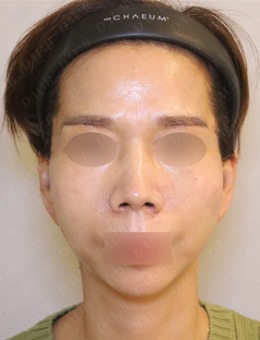 韓國Dal:B整形外科面部抗衰前后對比顯著,皺紋和膚質(zhì)都得到了改善!