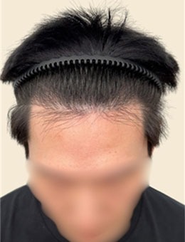 韓國Pinpoint Lab半永久店紋發(fā)技術出色，男士發(fā)際線紋的很自然！