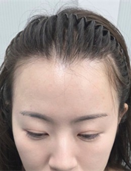 韓國Dottism半永久店紋發(fā)際線對比圖來啦！術(shù)后還真是挺自然的哦！