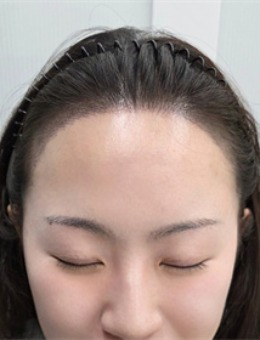 韓國Dottism半永久店紋發(fā)際線對比圖來啦！術(shù)后還真是挺自然的哦！