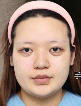 韓國(guó)答必達(dá)整形醫(yī)院做鼻整形技術(shù)好,配合雙下巴吸脂手術(shù)側(cè)顏簡(jiǎn)直絕了!
