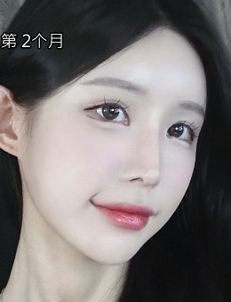 韓國(guó)答必達(dá)整形外科開眼角修復(fù)手術(shù)前后對(duì)比圖分享！術(shù)后2個(gè)月已經(jīng)好滿意了~?