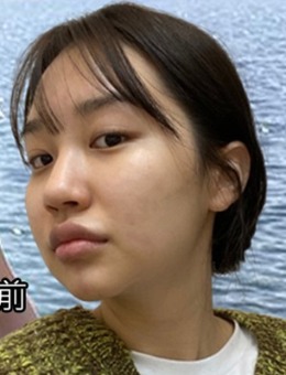 韓國答必達(dá)整形隆鼻術(shù)怎么樣?分享我從塌鼻到挺翹過程,形象躍升重拾自信!