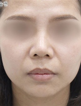 韓國selfi整形外科做面部提升技術(shù)好，術(shù)后面部緊致年輕好幾歲！