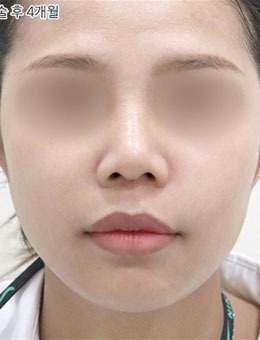 韓國selfi整形外科做面部提升技術(shù)好，術(shù)后面部緊致年輕好幾歲！
