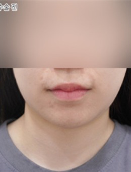 韓國selfi整形外科做雙下巴前后對比，術(shù)后美出新高度！