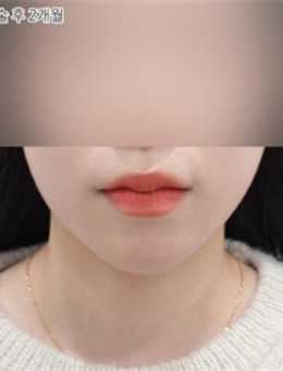 韓國selfi整形外科做雙下巴前后對比，術(shù)后美出新高度！