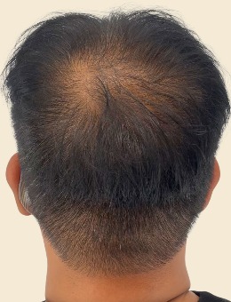 韓國Pinpoint Lab半永久店頭頂紋發(fā)技術(shù)絕了，不用手術(shù)也能get濃密頭發(fā)