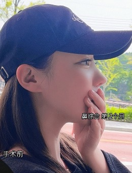 韓國答必達整形隆鼻屬于自然媽生鼻風格！白開水隆鼻必選！