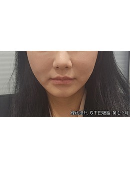 韓國(guó)答必達(dá)整形埋線提升+雙下巴吸脂親身經(jīng)歷分享,感受修復(fù)期短還收費(fèi)合理!