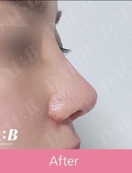 韩国Dal.B整形外科隆鼻术例欣赏：get属于自己的自然款鼻子，拒绝复制粘贴~