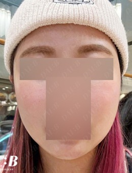 在韩国Dal:B整形外科做完面部提升后脸都小了一圈！从圆脸到小V脸就是这么简单！
