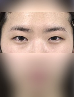 -我在韩国owbom医院做了双眼皮手术，好自然的灵动小鹿眼术后我都惊呆了~