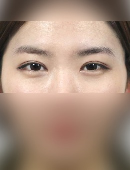 -我在韩国owbom医院做了双眼皮手术，好自然的灵动小鹿眼术后我都惊呆了~
