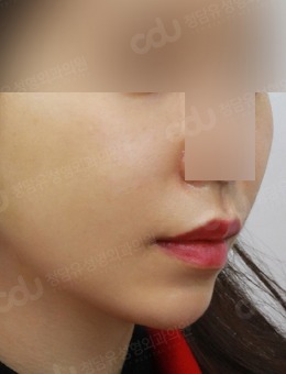 韩国OWBOM医院双下巴消除太绝了！下颌线紧致到朋友都震惊～