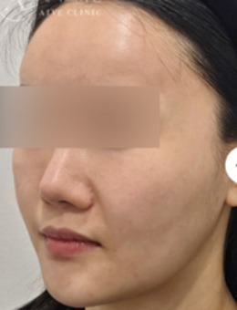 韓國(guó)AIVE皮膚科提升緊致實(shí)錄｜變化看得見，自然到像媽生好皮