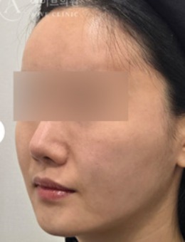 韓國(guó)AIVE皮膚科提升緊致實(shí)錄｜變化看得見，自然到像媽生好皮