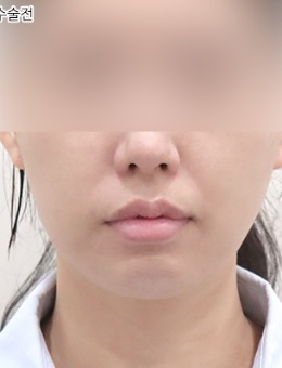 韩国selfi整形外科双下巴整形实例分享，同时解决颏下脂肪堆积与皮肤松弛问题！
