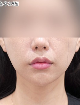 韩国selfi整形外科双下巴整形实例分享，同时解决颏下脂肪堆积与皮肤松弛问题！
