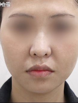 韩国selfi整形外科面部提升实例分享：法令纹消退，轮廓也更清晰！