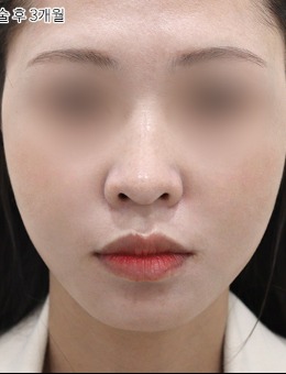 韩国selfi整形外科面部提升实例分享：法令纹消退，轮廓也更清晰！