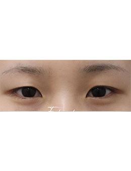 清潭es整形外科眼整形怎么样?分层剥离技术加持,自然无痕体验好
