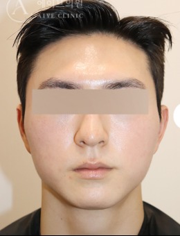 韩国aive皮肤科做男士美容护肤很不错，前后对比图查看！