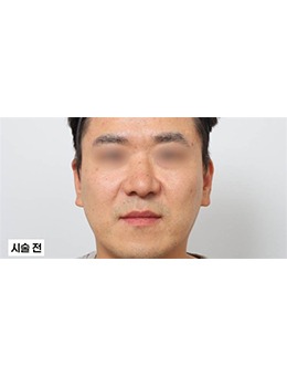 韩国新整形外科：分层填法令纹消“括号脸”，术后3个月素颜也敢露笑容