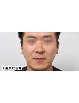 韩国新整形外科：分层填法令纹消“括号脸”，术后3个月素颜也敢露笑容