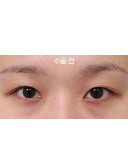 -韩国新整形外科眼部整形｜术后 7 天变化好明显！自然灵动眼太绝了