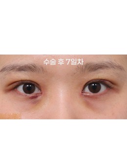 -韩国新整形外科眼部整形｜术后 7 天变化好明显！自然灵动眼太绝了
