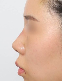 韩国新整形外科做鼻子技术好，真人鼻部整形前后对比令人惊艳！