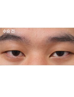 韩国新整形外科男士双眼皮手术对比，男士专属 “微创 + 自然” 变美套路！