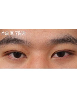 韩国新整形外科男士双眼皮手术对比，男士专属 “微创 + 自然” 变美套路！