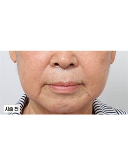 在韩国新整形外科做口周整形：术前显老态，术后唇周精致，前后对比差距好大