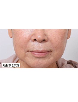 在韩国新整形外科做口周整形：术前显老态，术后唇周精致，前后对比差距好大