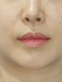 韩国梅宗德皮肤科下颌线改善对比:两个月,下颌线从“模糊”到“清晰”,轮廓逆袭成功