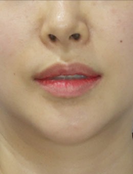 韩国梅宗德皮肤科下颌线改善对比:两个月,下颌线从“模糊”到“清晰”,轮廓逆袭成功