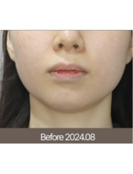 围观梅宗德皮肤科案例：下颌线从模糊到清晰，奥利塞拉 + 西马吉联合治疗轮廓清晰了！