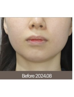 围观梅宗德皮肤科案例：下颌线从模糊到清晰，奥利塞拉 + 西马吉联合治疗轮廓清晰了！