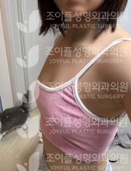 韩国喜悦整形外科隆胸术例分享:从扁平到饱满,重塑胸部曲线魅力