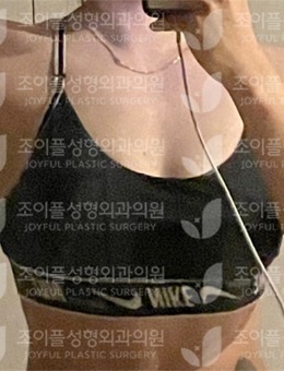 韓國喜悅整形隆胸手術(shù)對比圖公開，術(shù)后胸型自然飽滿手感真實(shí)！