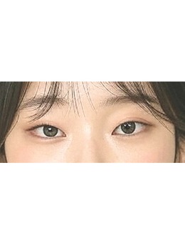 韩国The Swan整形外科双眼皮术例｜定制专属灵动眼，美到心坎里！