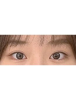 韩国The Swan整形外科做眼尾提升真的好！双眼皮线条流畅眼尾提升明显，疤痕隐蔽无痕！