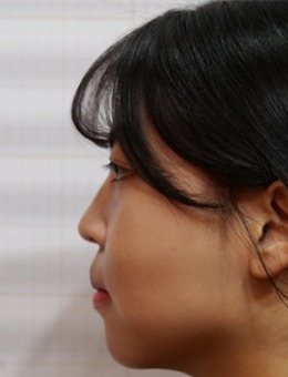 韩国釜山jryn皮肤科鼻子玻尿酸，让侧面轮廓线从扁平变得立体！