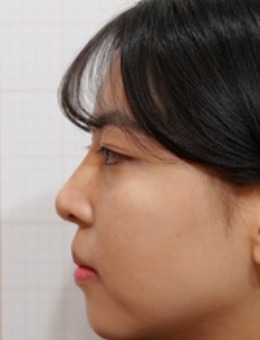 韩国釜山jryn皮肤科鼻子玻尿酸，让侧面轮廓线从扁平变得立体！