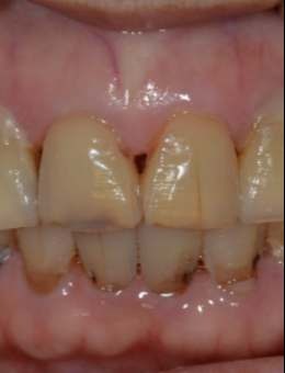 韩国NewYorkWhite牙科牙齿修复对比:现代牙科修复技术的奇迹,从暗淡失色到璀璨夺目