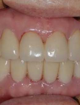 韩国NewYorkWhite牙科牙齿修复对比:现代牙科修复技术的奇迹,从暗淡失色到璀璨夺目